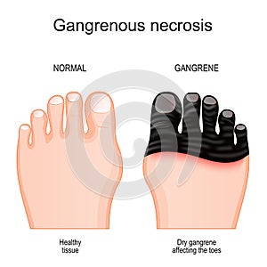 Gangrene affecting the toes.. tissue death by Gangrenous necrosis