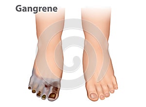 Gangrene is a type of tissue death caused.