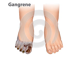 Gangrene is a type of tissue death caused. photo