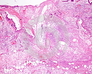 Gangrenous cholecystitis photo