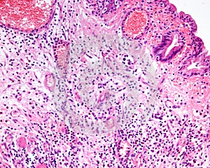 Gangrenous cholecystitis photo