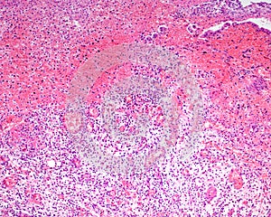 Gangrenous cholecystitis photo