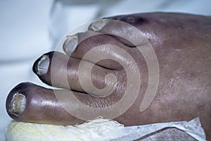 Gangrenous foot on a Male Patient
