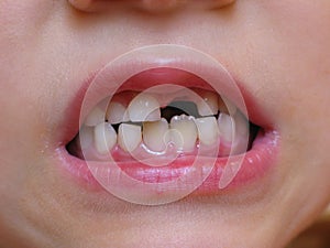 Espacio dentado sonrisa afectada 