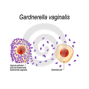 Gardnerella vaginalis. Vaginal epithelial clue cell coated with bacteria