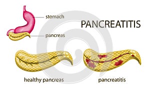 Gaster and pancreatitis