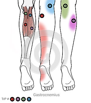 Gastocnemius calf muscle myofascial trigger points