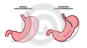 Gastrectomy and gastroplasty