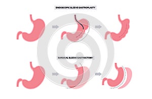 Gastrectomy and gastroplasty