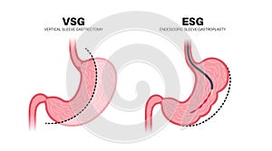 Gastrectomy and gastroplasty