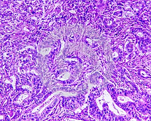 Gastric adenocarcinoma of a human