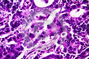 Gastric adenocarcinoma, light micrograph
