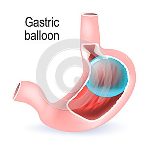 Gastric balloon. inflatable medical device for reduce weight.