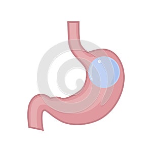 Gastric Balloon Stomach