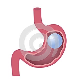 Gastric Balloon Stomach