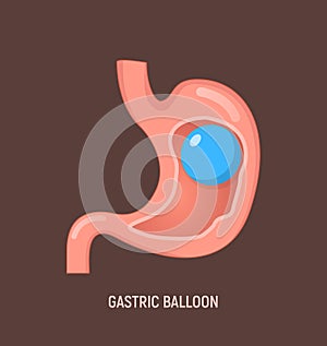 Gastric balloon weight loss intragastric surgery. Stomach gastric balloon operation vector icon