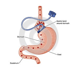 Gastric band operation