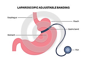 Gastric band poster