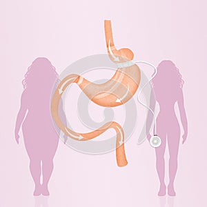 Gastric band to reduce stomach