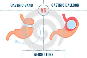 Gastric band vs gastric balloon bariatric surgery weight loss infographics