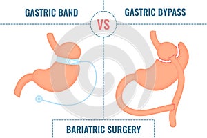 Gastric band vs gastric bypass bariatric surgery weight loss infographics