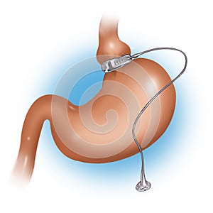 Gastric Band Weight Loss Surgery