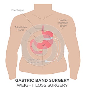 Gastric Band Weight Loss Surgery