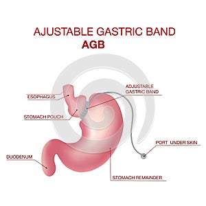 Gastric Band Weight Loss Surgery.Band with a Port that Under the Skin