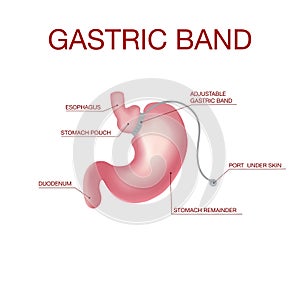 Gastric Band Weight Loss Surgery.Band with a Port that Under the Skin