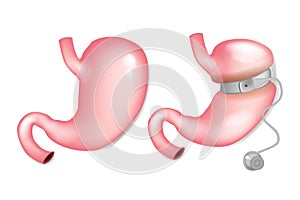 Gastric Banding Surgery