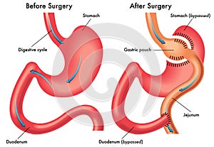 Gastric bypass