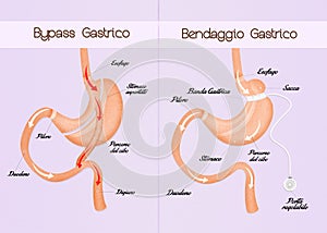 Gastric bypass and gastric band