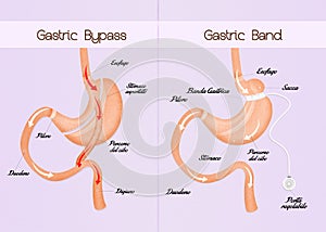 Gastric bypass and gastric band