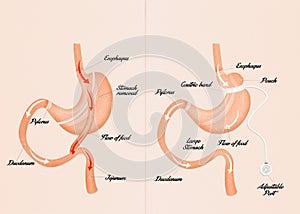 Gastric bypass and gastric band