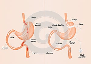 Gastric bypass and gastric band