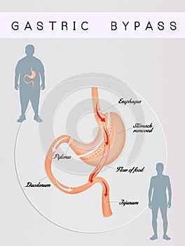 Gastric bypass surgery
