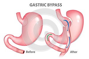 Gastric bypass surgery