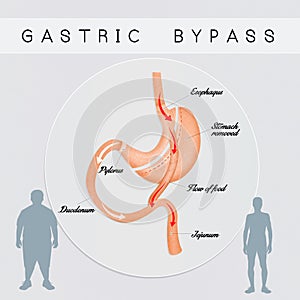 Gastric bypass surgery