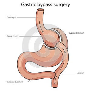 Gastric bypass surgery diagram medical science