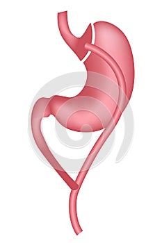 Gastric bypass. Treatment of obesity with surgery.