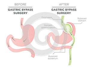 Gastric Bypass for Weight Loss