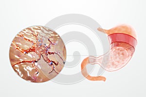 Gastric cancer, tumor, human anatomy. Concept health care, disease, medicine, biology, chemotherapy. 3D rendering, 3D illustration photo