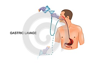 Gastric lavage with a gastric tube