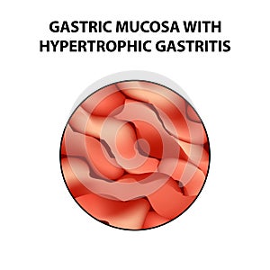 Gastric mucosa with hypertrophic gastritis. Infographics. Vector illustration on isolated background