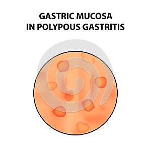 Gastric mucosa in polypous gastritis. Infographics. Vector illustration on isolated background