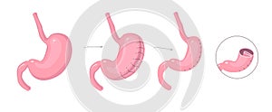 Gastric plication infographics. The explanation picture of stomach reduce method via laparoscopic operation