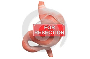 Gastric resection concept. Human stomach with For Resection hanging sign, 3D rendering