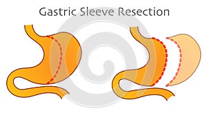 Gastric Sleeve Resection. Vertical stomach reduction bypass, operation. Tube fat surgery. Cross section anatomy, diagram. Cut mark