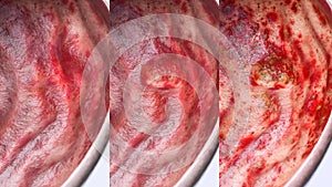 Gastric ulcer in various stages- high degree of detail - 3D Rendering photo