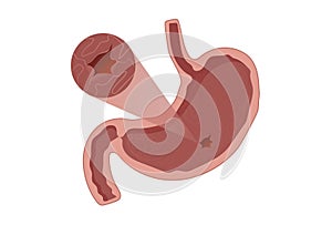 Stomach ulcer vector illustration photo